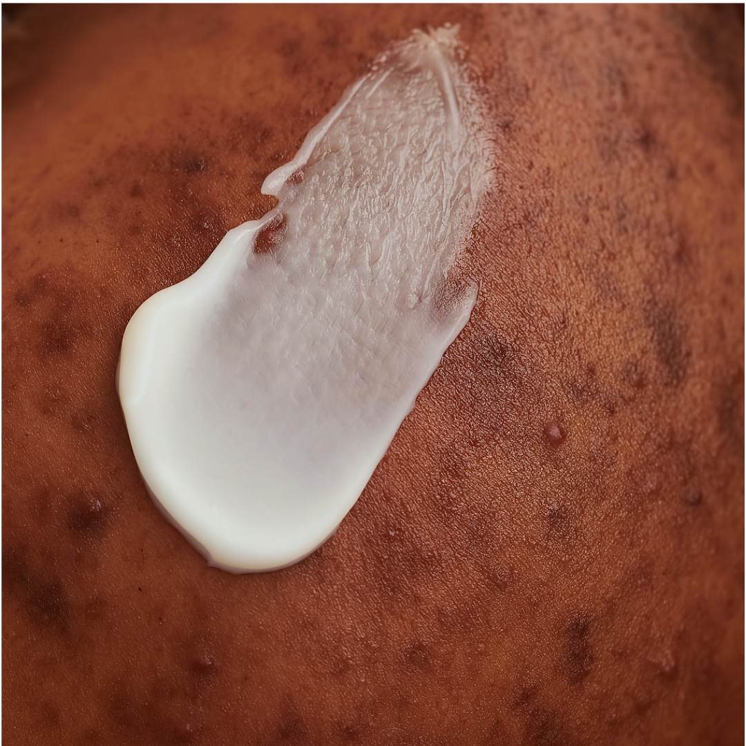 Anwendung der DADO SENS PURDERM Waschcreme – cremige Textur auf unreiner Haut aufgetragen